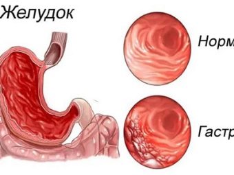 Картофель для применения лечения геморроя