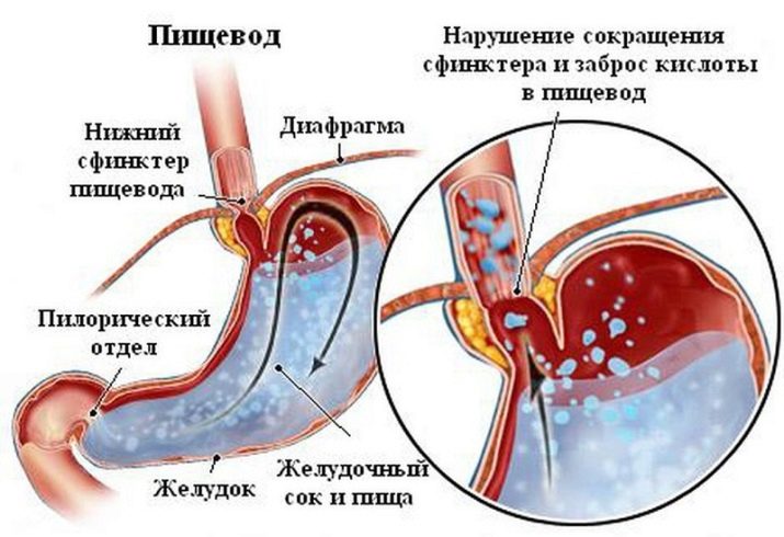 Творог на завтрак при гастрите